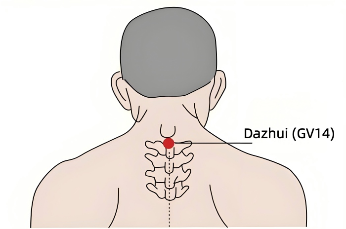 Cold and flu moxibustion therapy: Dazhui (GV14)