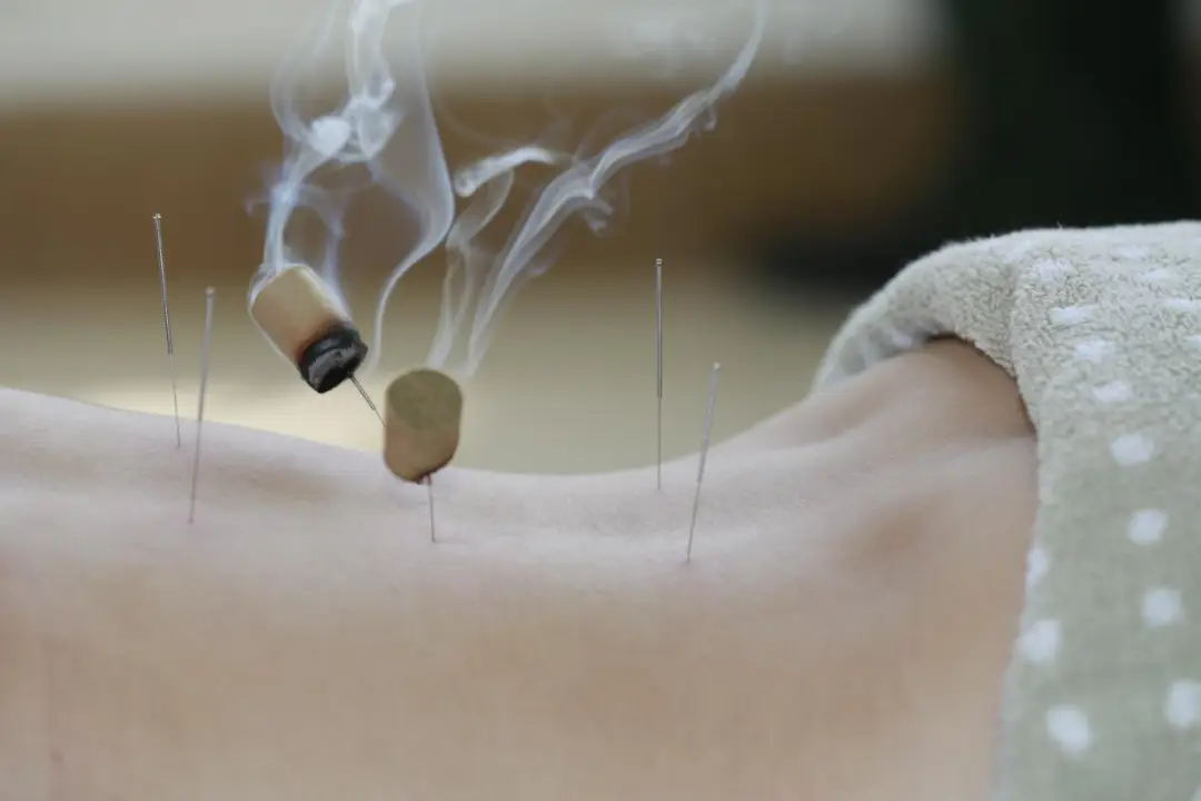 moxibustion acupuncture