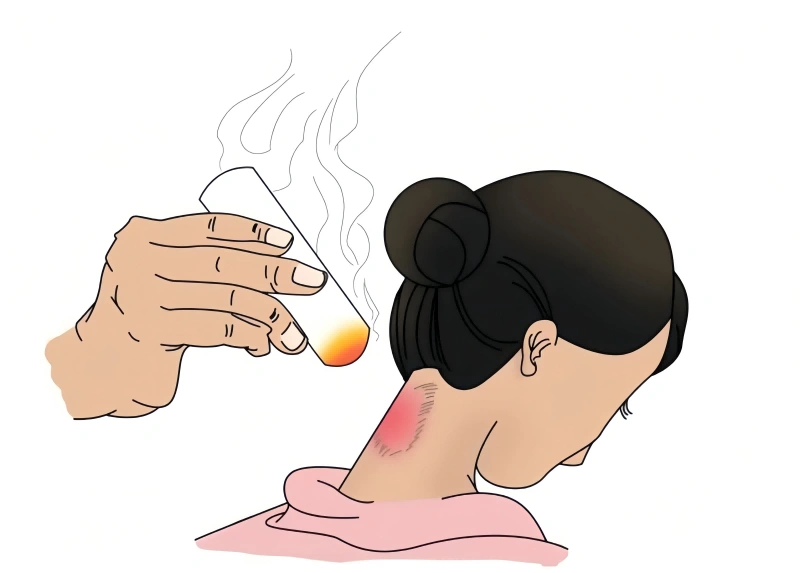 Moxibustion Burns