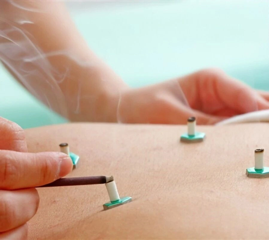 Moxibustion Burns