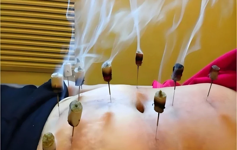 moxibustion acupuncture 
