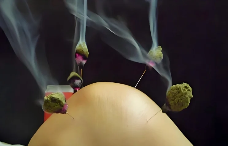 moxibustion acupuncture